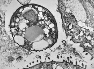 M,33y. | cryptosporidiosis - duodenum, im | munodeficient pacient M,33y. | cryptosporidiosis - duodenum, im | munodeficient pacient